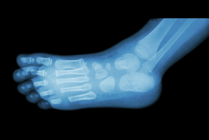 x-ray of foot